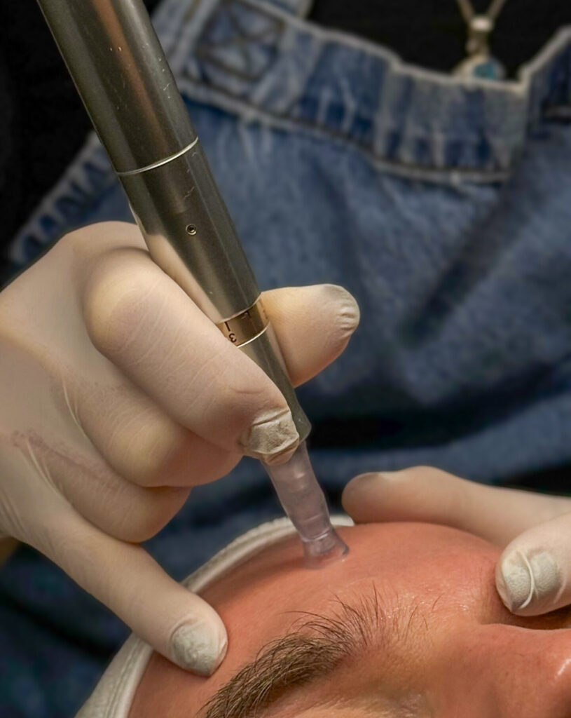 Derma SR -mikroneulaushoidon hoitotuotteet